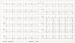 Aktuelles Bild - Abb. 2: Vorhofflattern