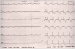 Abb. 1: EKG