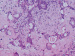 Abb. 5: Lebermetastasen