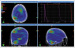 Fig. 1: Brain Radiotherapy