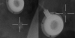 Aktuelles Bild - Abb. 1: ESWL