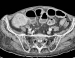 Aktuelles Bild - Abb. 2a: Abdomen - Tumor