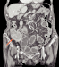 Abb. 2b: Tumor - Zkum