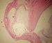 Abb. 1: Appendix - Neoplasma