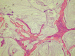 Abb. 4: Pseudomyxoma peritonei