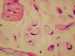 Abb. 5: Pseudomyxoma peritonei
