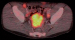 Abb. 5: DSRCT-Knoten