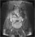 Abb. 1: VCI - Thrombose