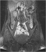 Aktuelles Bild - Abb. 2: Antikoagulation - Restthrombose