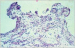 Abb. 3: Ependymom