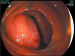 Abb. 5: Tumor - Ileum