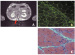 Fig. 2a-c: Stem cell transplant