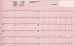 Abb. 1: Elektrokardiogramm