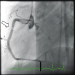Abb. 1: Rechte Koronararterie