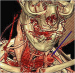 Abb. 5: Sakkiformes Aneurysma