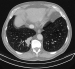 Aktuelles Bild - Abb. 2c : Thorax-CT