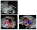 Abb. 1a-c: Placenta praevia percreta