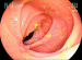Abb. 4: M. Crohn 