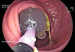 Abb. 5: M. Crohn