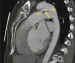 Abb. 8: CT-PDA