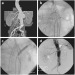 Abb. 1a-d: Fenestrierte Endoprothese