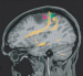 Fig. 1: Glioma - Surgery