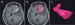 Fig. 2a-c: Glioma - Surgery