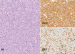 Fig. 3: B-cell Lymphoma