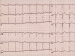 Aktuelles Bild - Abb. 2: Artefakt bei Hyperventilation