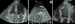 Abb. 12a-c: Vorhofmyxom - Thrombus