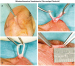 Aktuelles Bild - Abb. 1a-d: Minimalinvasive Vasektomie