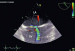 Abb. 5: Interatriales Septum