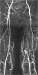 Abb. 1: Arteria femoralis superficialis