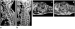 Aktuelles Bild - Abb. 1a-d: Spinales Hmatom