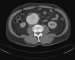 Abb. 1: Aortenaneurysma