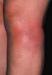 Aktuelles Bild - Abb. 1: Erythema nodosum