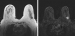 Aktuelles Bild - Abb. 2li-re: Mammographie