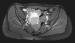 Aktuelles Bild - Abb. 1: DSRCT