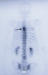 Abb. 1: Skelettmetastasen
