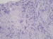 Abb. 3a: Mammakarzinom
