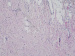 Abb. 3b: Mammakarzinom