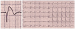 Aktuelles Bild - Abb. 1: Brugada-Syndrom