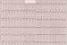 Abb. 1: EKG