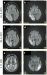Aktuelles Bild - Abb. 1a-f: MELAS-Syndrom