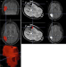 Fig. 1a-c: Seizures