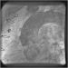 Aktuelles Bild - Abb. 1: Catheter-Induced Dissection