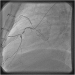 Abb. 4: Catheter-Induced Dissection