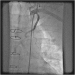 Abb. 5: Catheter-Induced Dissection