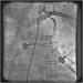 Abb. 6: Catheter-Induced Dissection