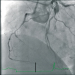 Abb. 1: Stenose - RCA